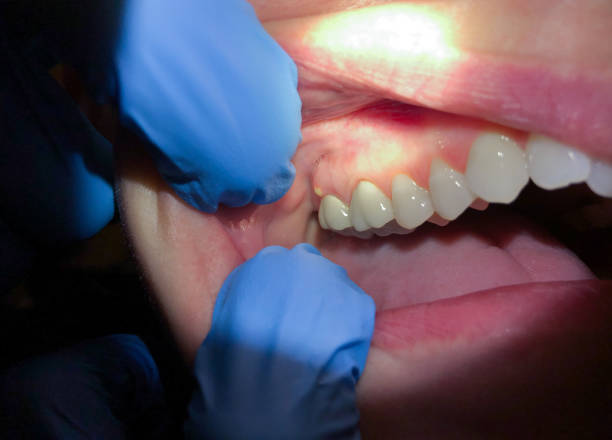 Best Emergency Gum Treatment in Clyde, TX